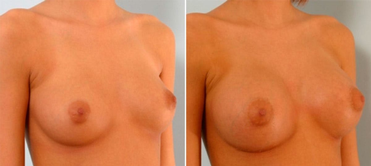 Breast Augmentation Before & After Photo - Patient 54885979 - Image 2