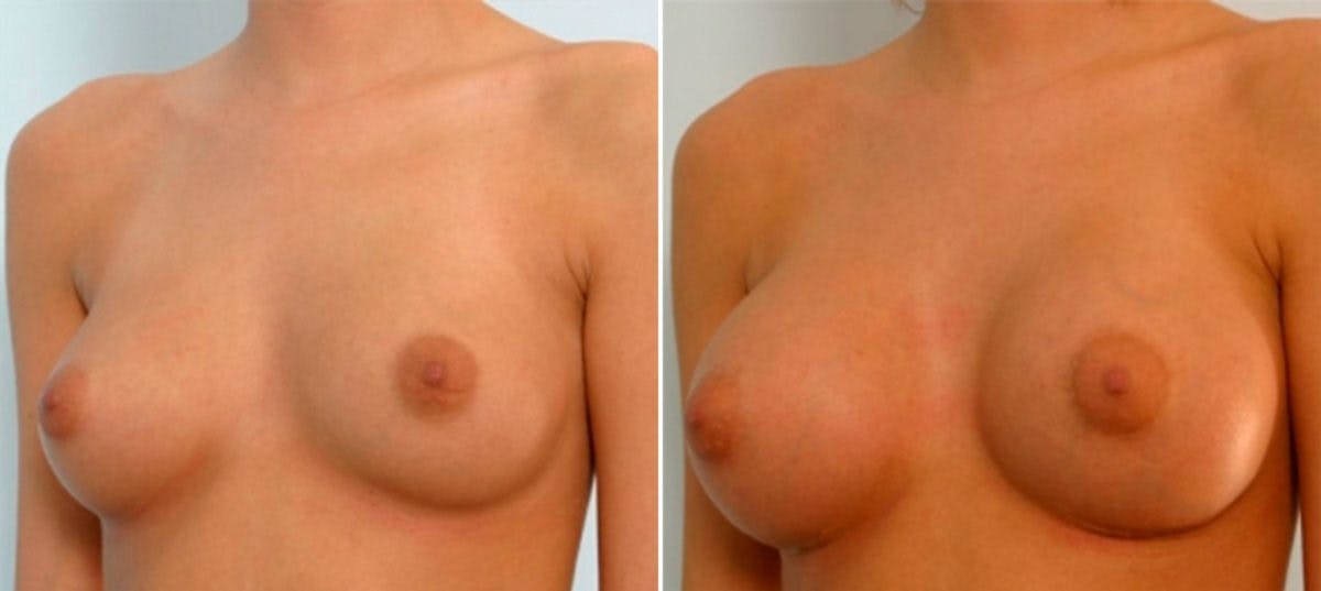 Breast Augmentation Before & After Gallery - Patient 54885979 - Image 4