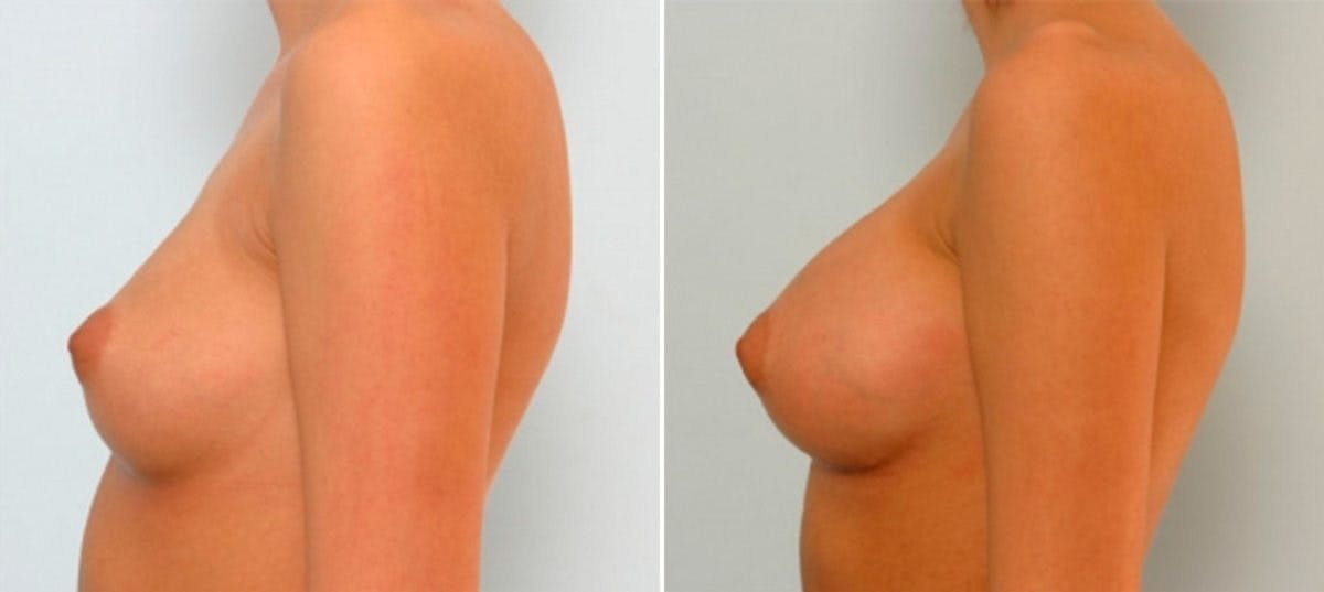 Breast Augmentation Before & After Gallery - Patient 54885979 - Image 5