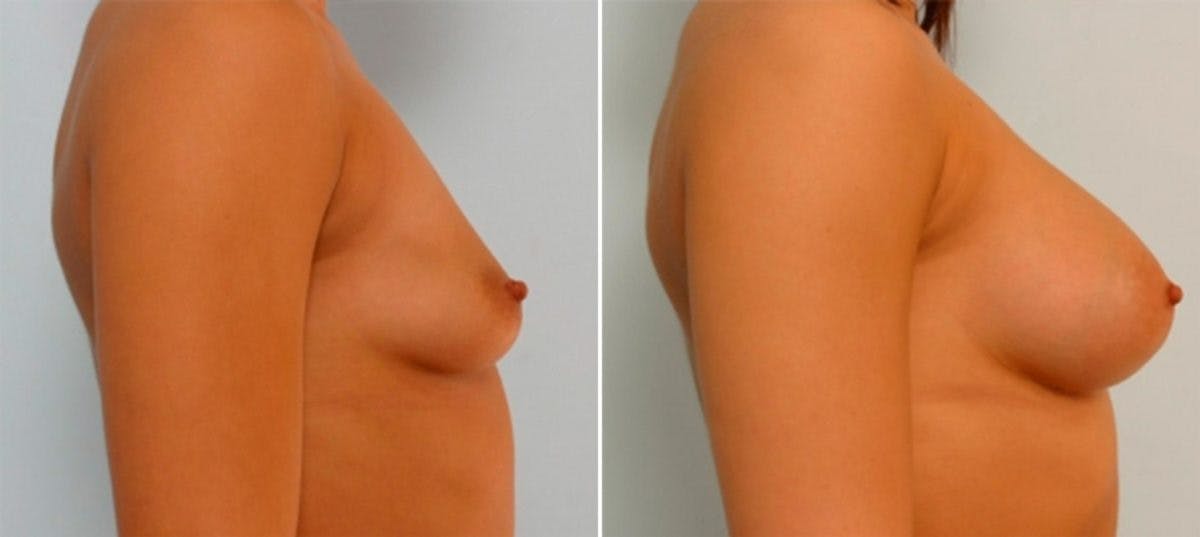 Breast Augmentation Before & After Gallery - Patient 54885980 - Image 3