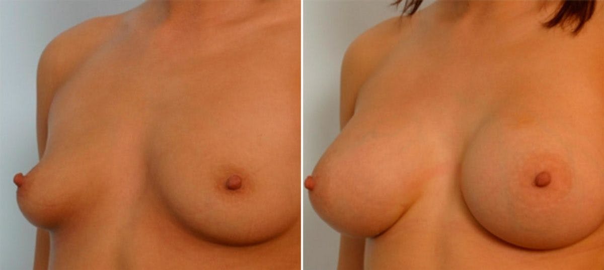 Breast Augmentation Before & After Gallery - Patient 54885980 - Image 4