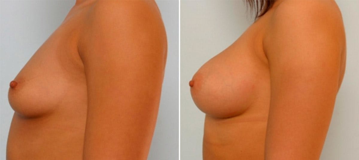 Breast Augmentation Before & After Gallery - Patient 54885980 - Image 5