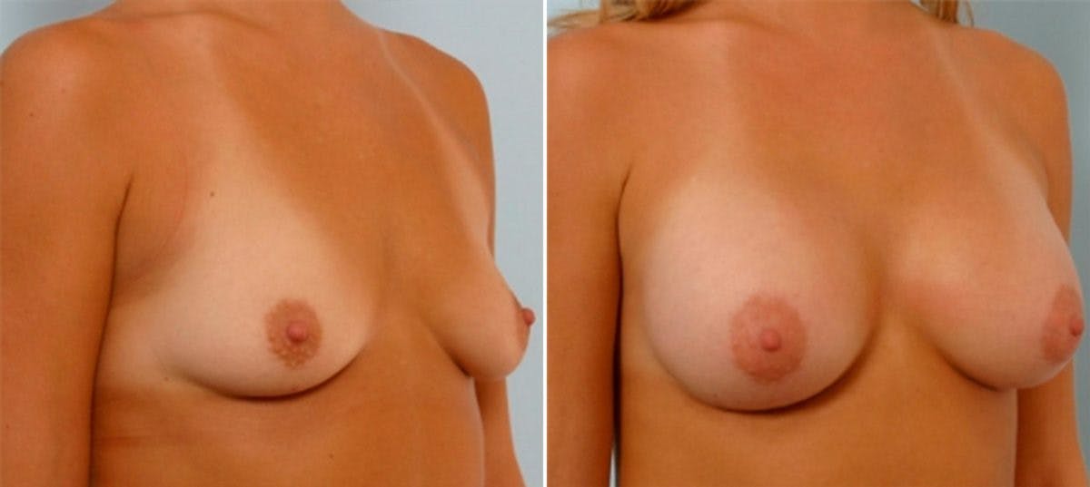 Breast Augmentation Before & After Photo - Patient 54885981 - Image 2