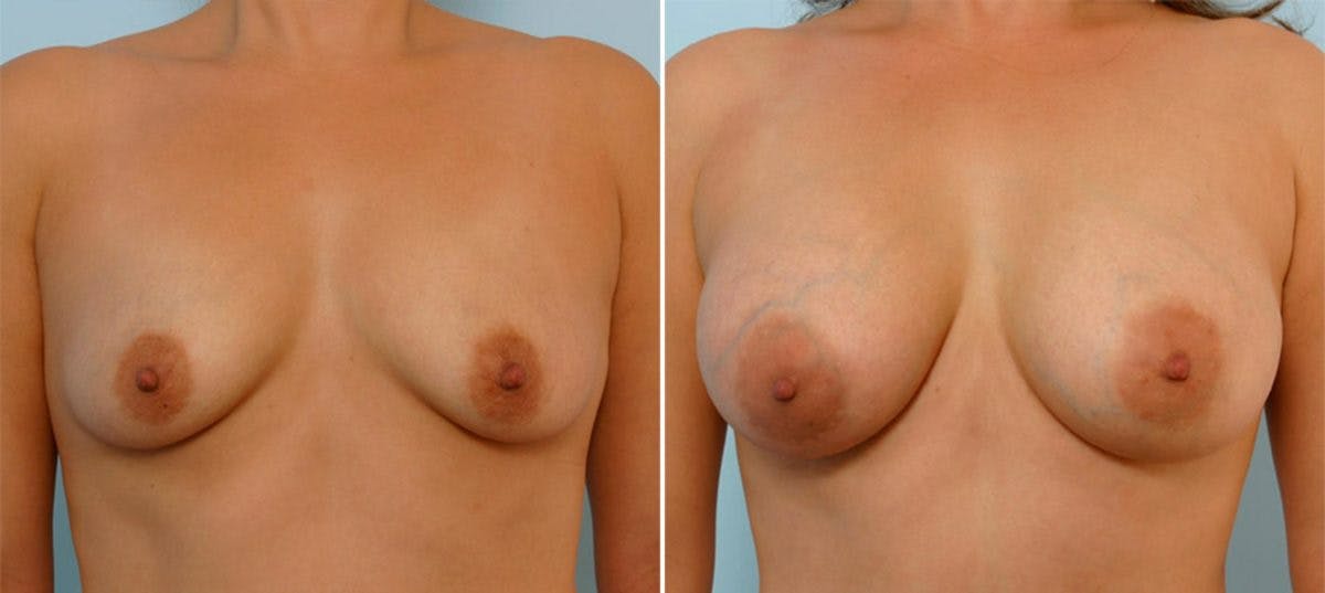 Breast Augmentation Before & After Gallery - Patient 54885982 - Image 1