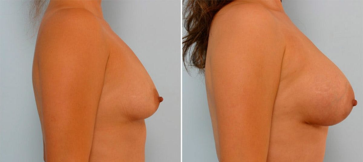 Breast Augmentation Before & After Gallery - Patient 54885982 - Image 3
