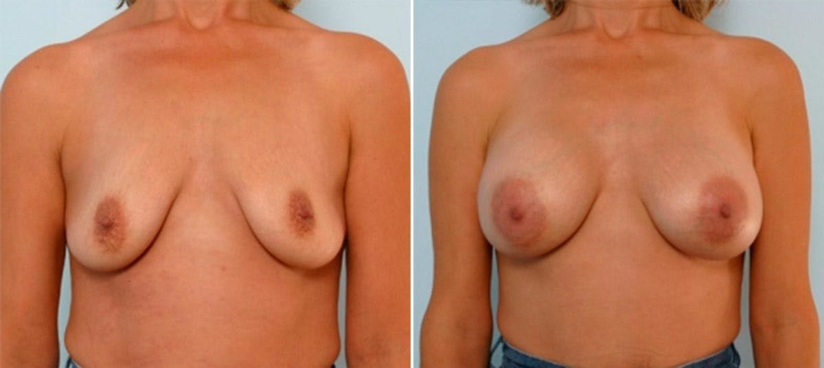 Breast Augmentation Before & After Gallery - Patient 54885983 - Image 1