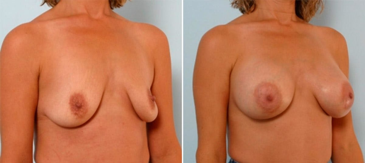 Breast Augmentation Before & After Gallery - Patient 54885983 - Image 2