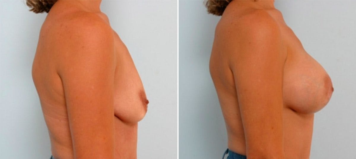 Breast Augmentation Before & After Gallery - Patient 54885983 - Image 3