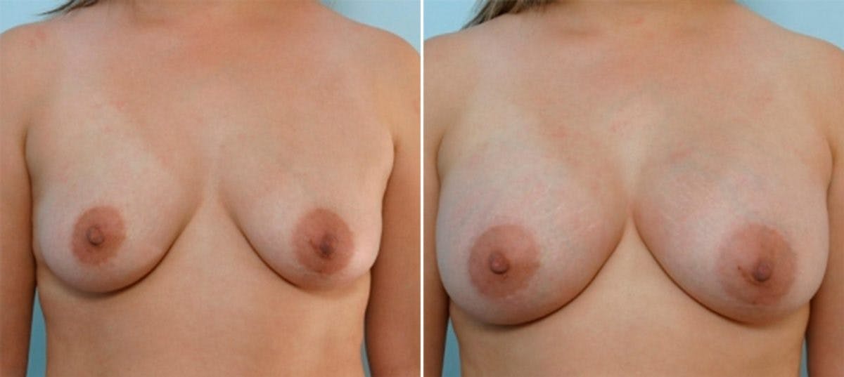 Breast Augmentation Before & After Gallery - Patient 54886598 - Image 1