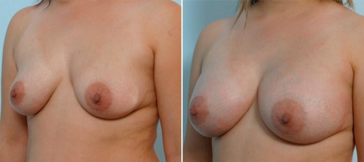 Breast Augmentation Before & After Gallery - Patient 54886598 - Image 3
