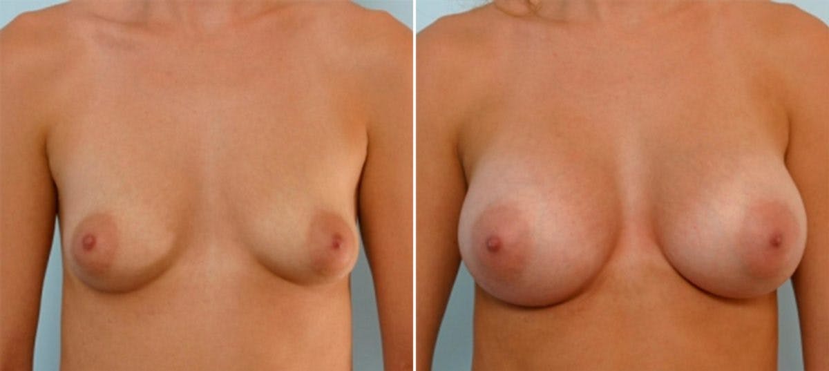 Breast Augmentation Before & After Gallery - Patient 54886600 - Image 1