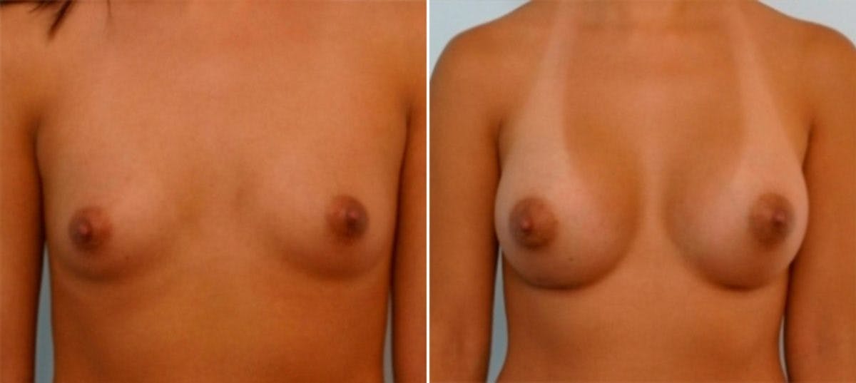 Breast Augmentation Before & After Gallery - Patient 54886601 - Image 1