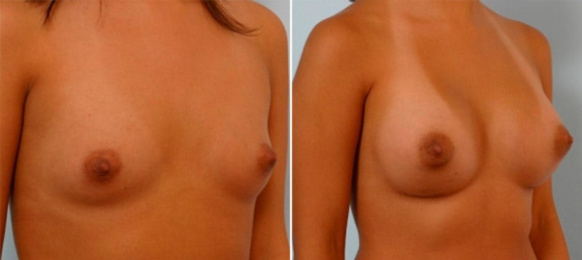 Breast Augmentation Before & After Gallery - Patient 54886601 - Image 2