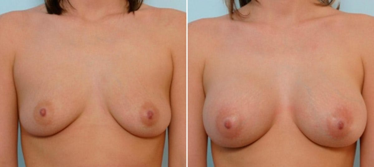 Breast Augmentation Before & After Gallery - Patient 54886624 - Image 1
