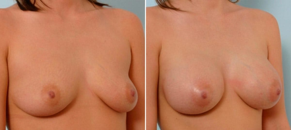 Breast Augmentation Before & After Gallery - Patient 54886624 - Image 2