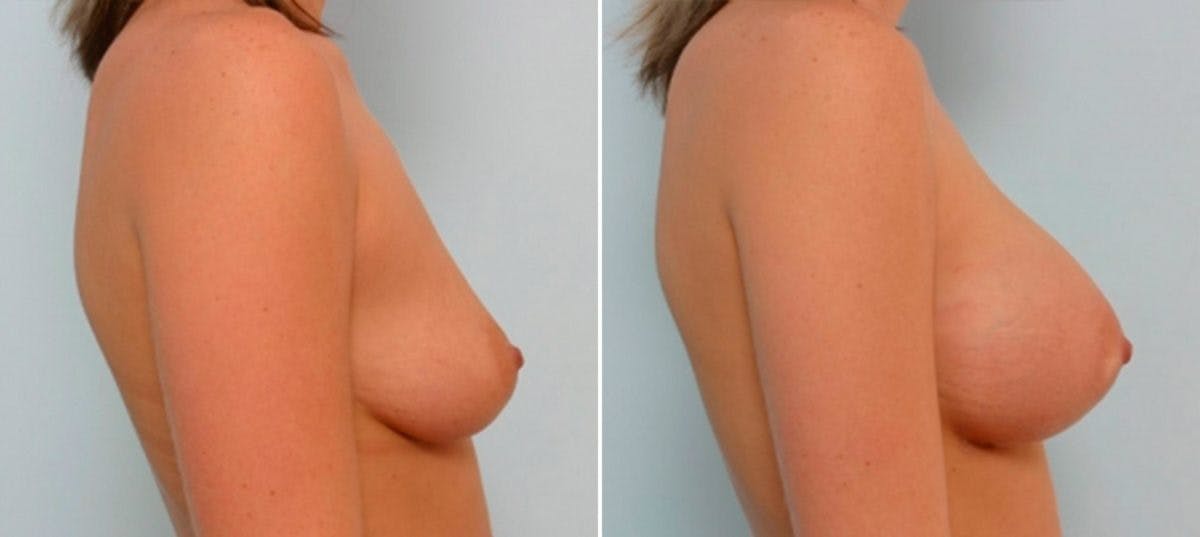 Breast Augmentation Before & After Gallery - Patient 54886624 - Image 3
