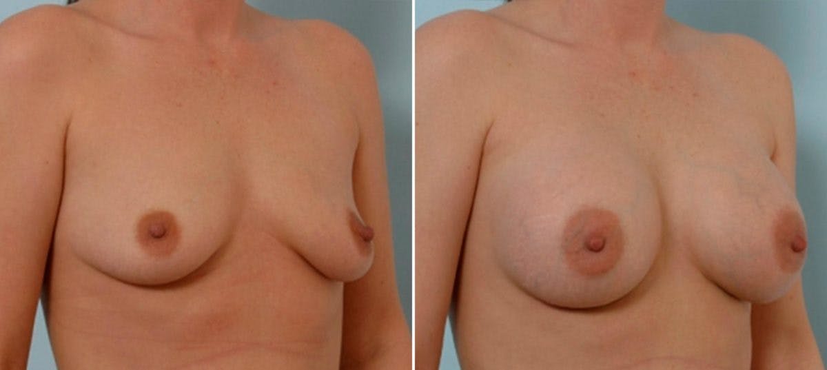 Breast Augmentation Before & After Gallery - Patient 54886627 - Image 2