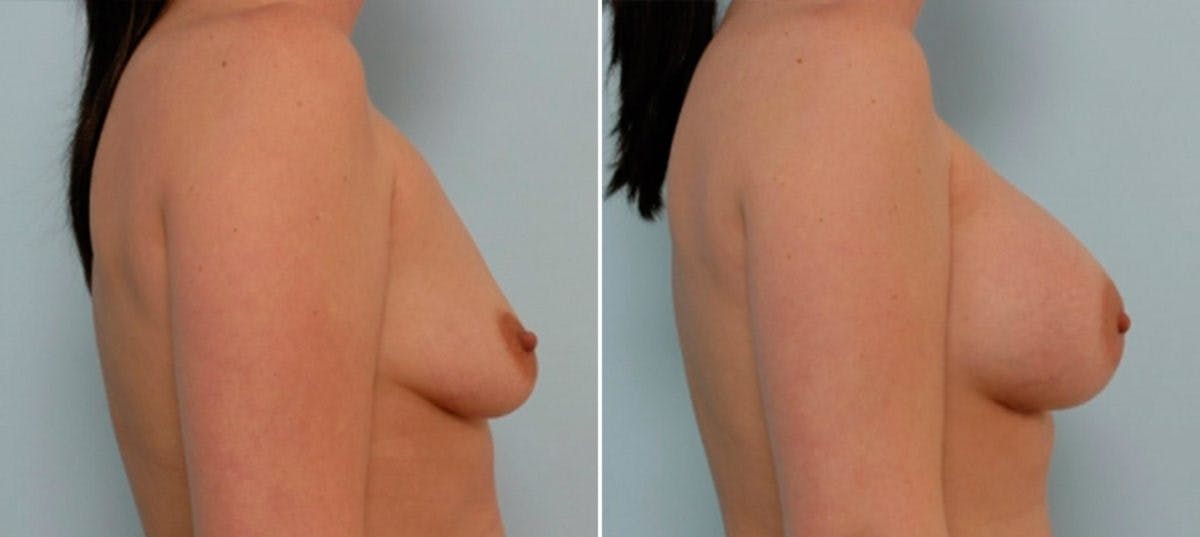 Breast Augmentation Before & After Gallery - Patient 54886627 - Image 3