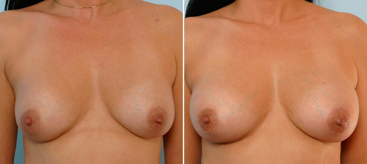 Breast Augmentation Before & After Gallery - Patient 54886628 - Image 1