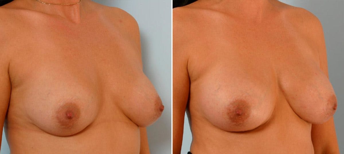 Breast Augmentation Before & After Gallery - Patient 54886628 - Image 3