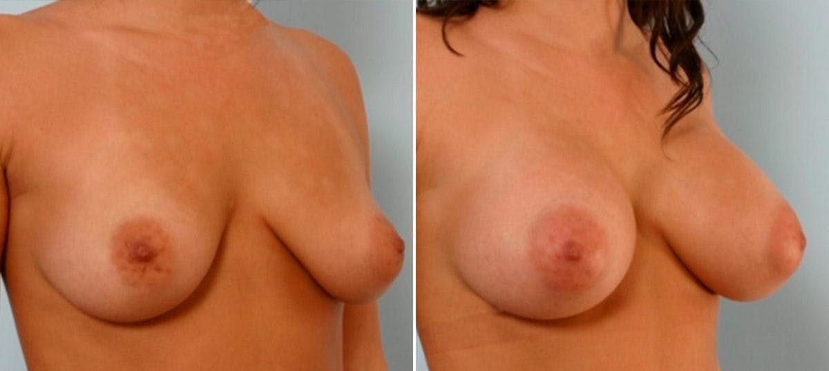 Breast Augmentation Before & After Gallery - Patient 54886629 - Image 2