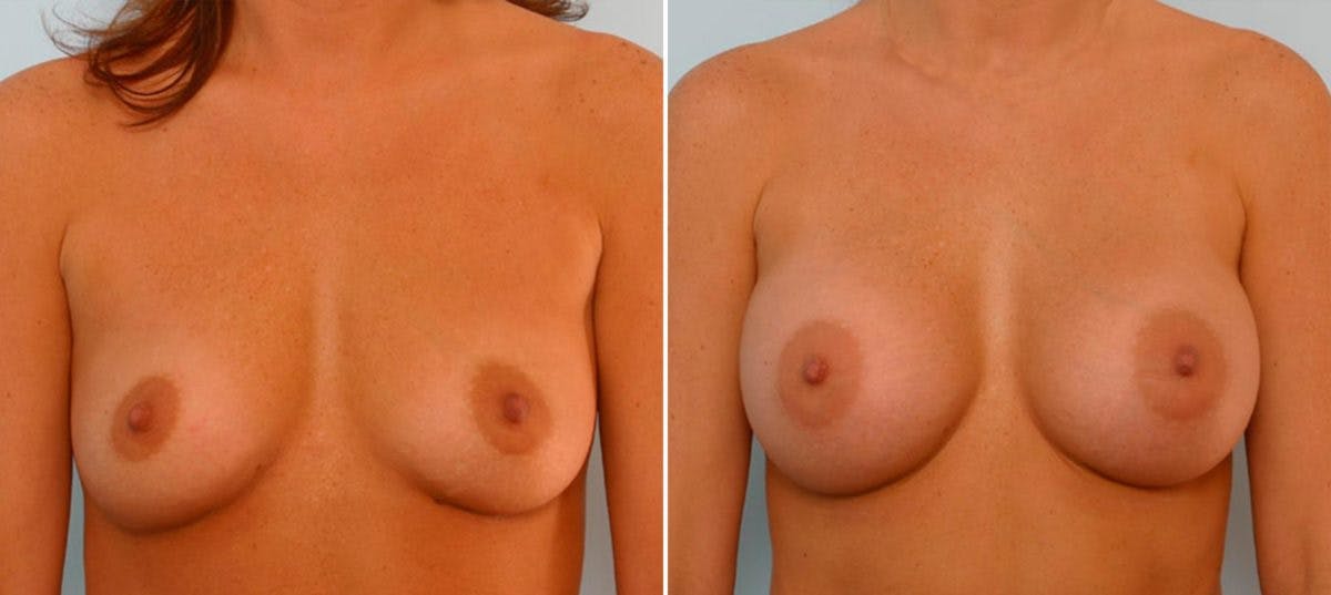 Breast Augmentation Before & After Gallery - Patient 54886631 - Image 1