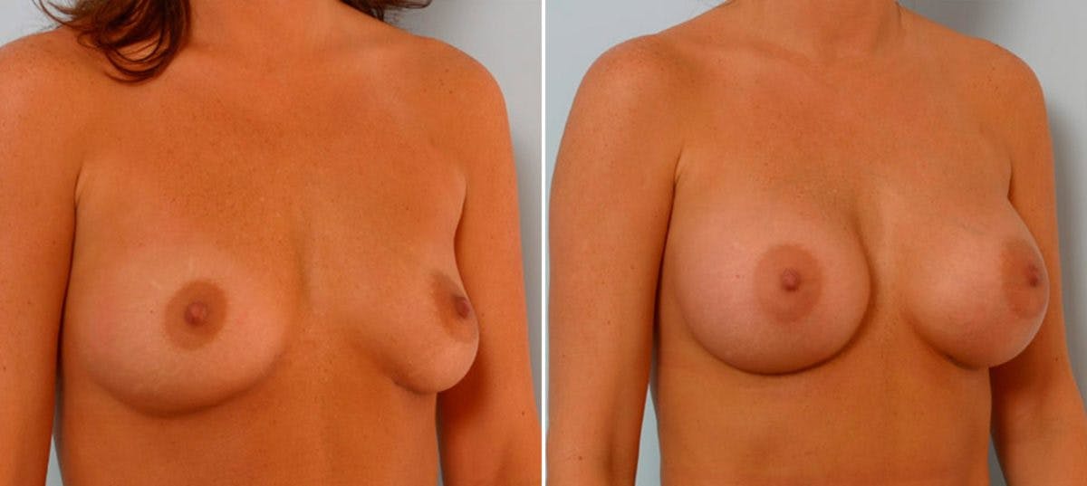 Breast Augmentation Before & After Gallery - Patient 54886631 - Image 2