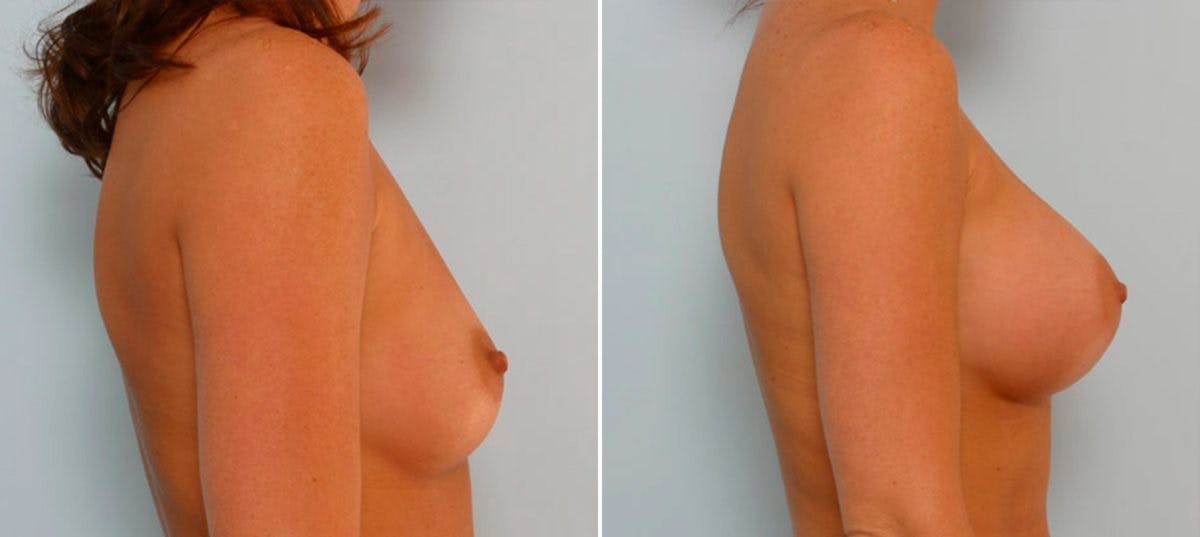 Breast Augmentation Before & After Gallery - Patient 54886631 - Image 3