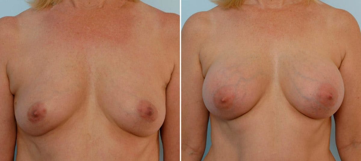Breast Augmentation Before & After Gallery - Patient 54886633 - Image 1