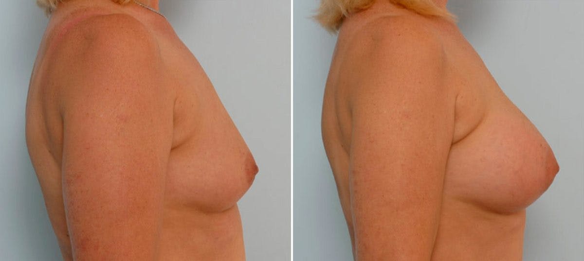 Breast Augmentation Before & After Gallery - Patient 54886633 - Image 3