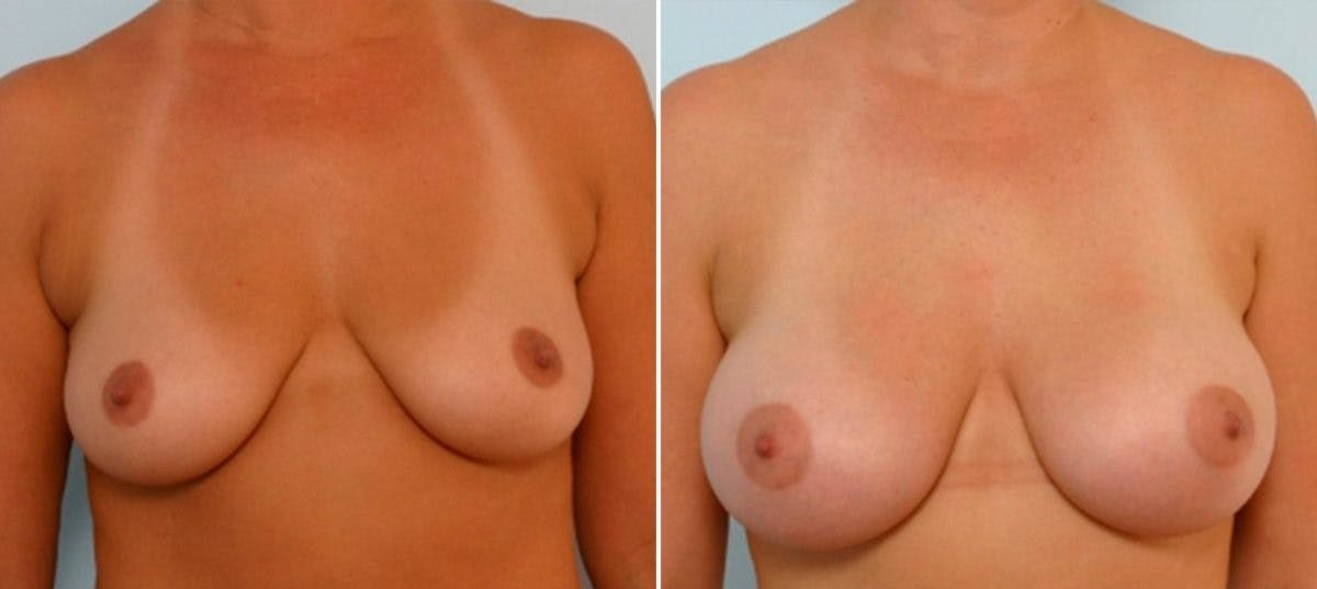Breast Augmentation Before & After Gallery - Patient 54886634 - Image 1
