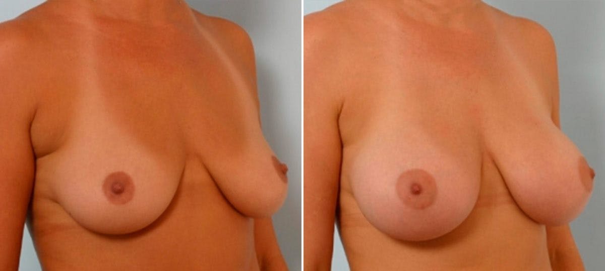 Breast Augmentation Before & After Photo - Patient 54886634 - Image 2