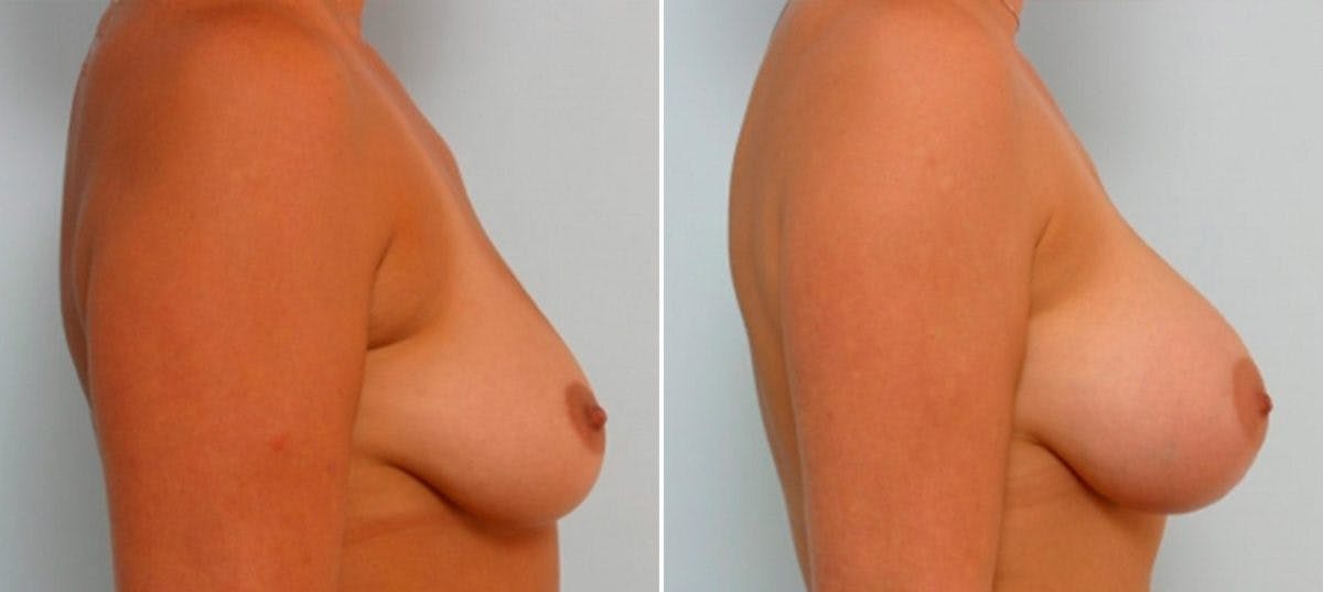 Breast Augmentation Before & After Gallery - Patient 54886634 - Image 3
