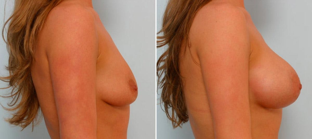 Breast Augmentation Before & After Gallery - Patient 54886635 - Image 3