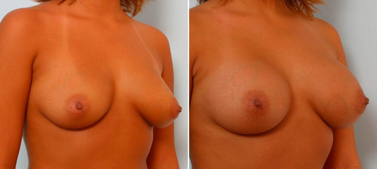 Breast Augmentation Before & After Gallery - Patient 54886638 - Image 2