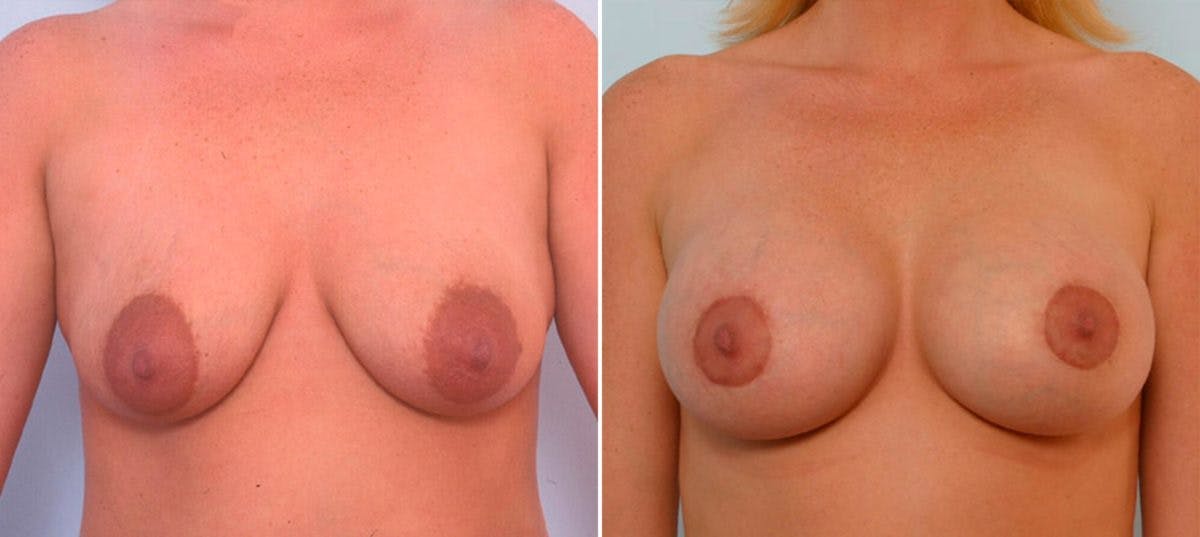 Breast Augmentation Before & After Gallery - Patient 54886641 - Image 1