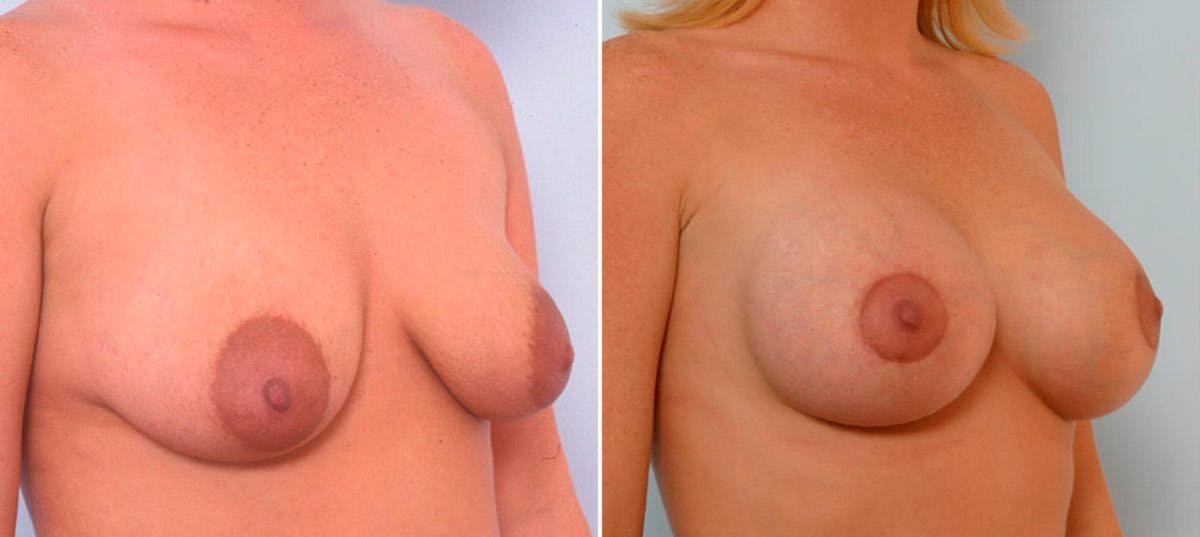 Breast Augmentation Before & After Gallery - Patient 54886641 - Image 2