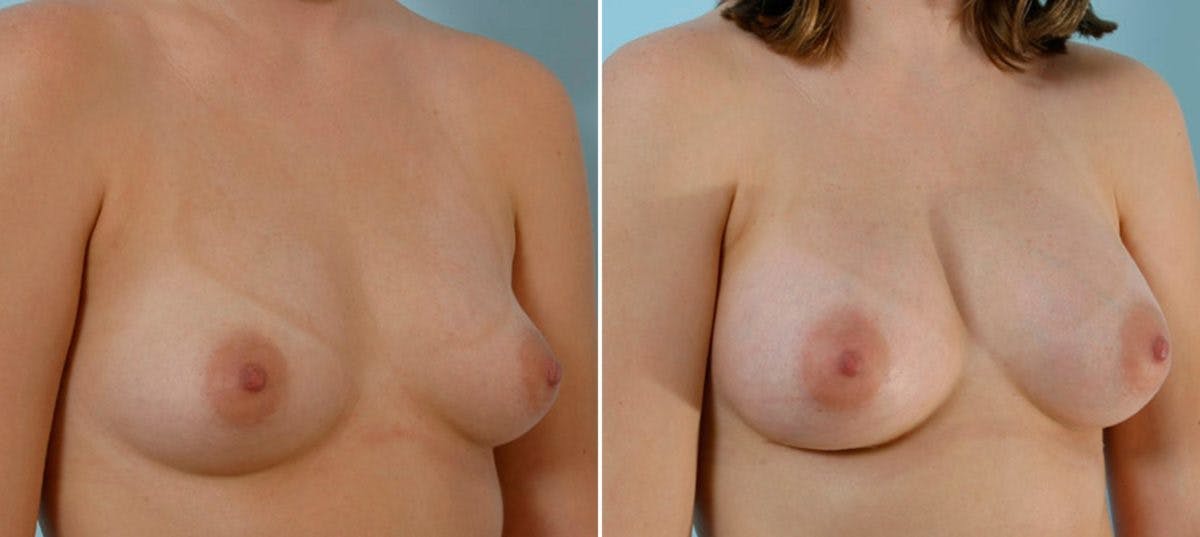 Breast Augmentation Before & After Gallery - Patient 54886642 - Image 2