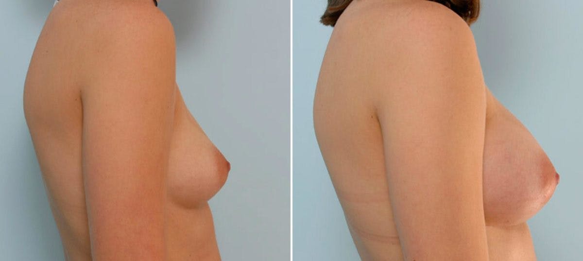 Breast Augmentation Before & After Gallery - Patient 54886642 - Image 3