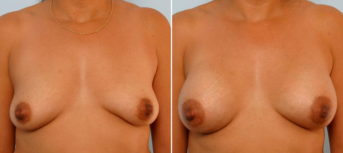 Breast Augmentation Before & After Gallery - Patient 54886647 - Image 1