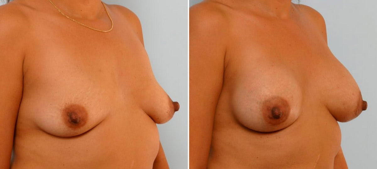 Breast Augmentation Before & After Gallery - Patient 54886647 - Image 2