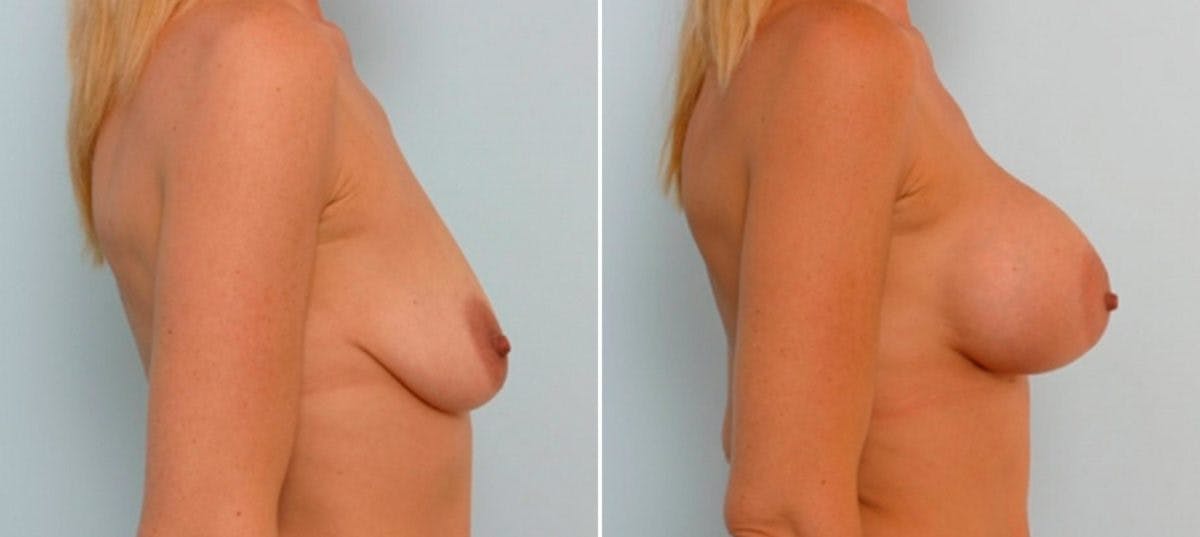 Breast Augmentation Before & After Gallery - Patient 54886648 - Image 2