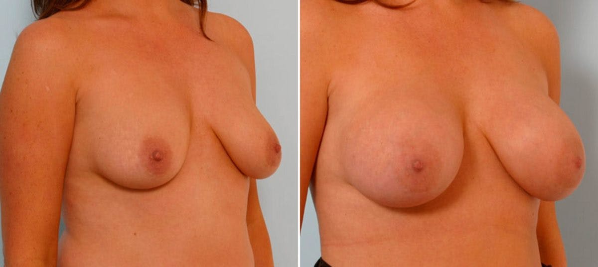 Breast Augmentation Before & After Gallery - Patient 54886649 - Image 2
