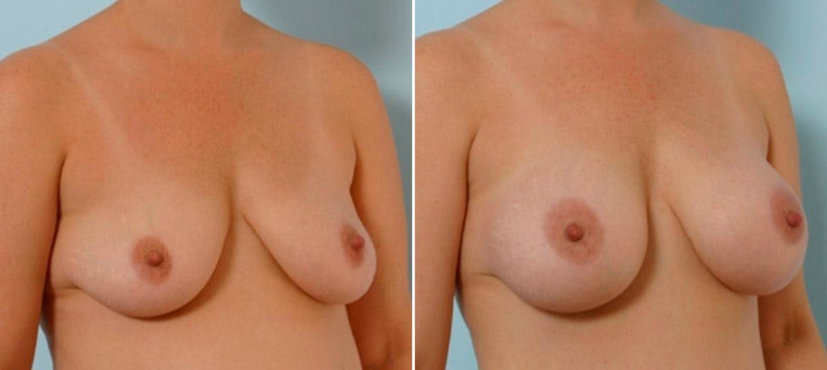 Breast Augmentation Before & After Gallery - Patient 54886650 - Image 2