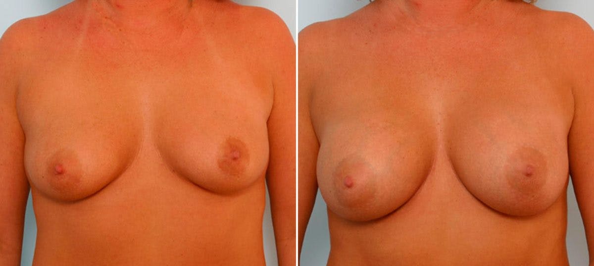 Breast Augmentation Before & After Gallery - Patient 54886653 - Image 1