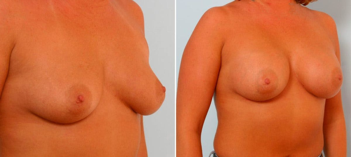 Breast Augmentation Before & After Gallery - Patient 54886653 - Image 2