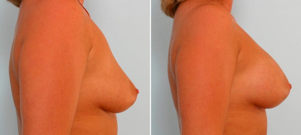 Breast Augmentation Before & After Gallery - Patient 54886653 - Image 3