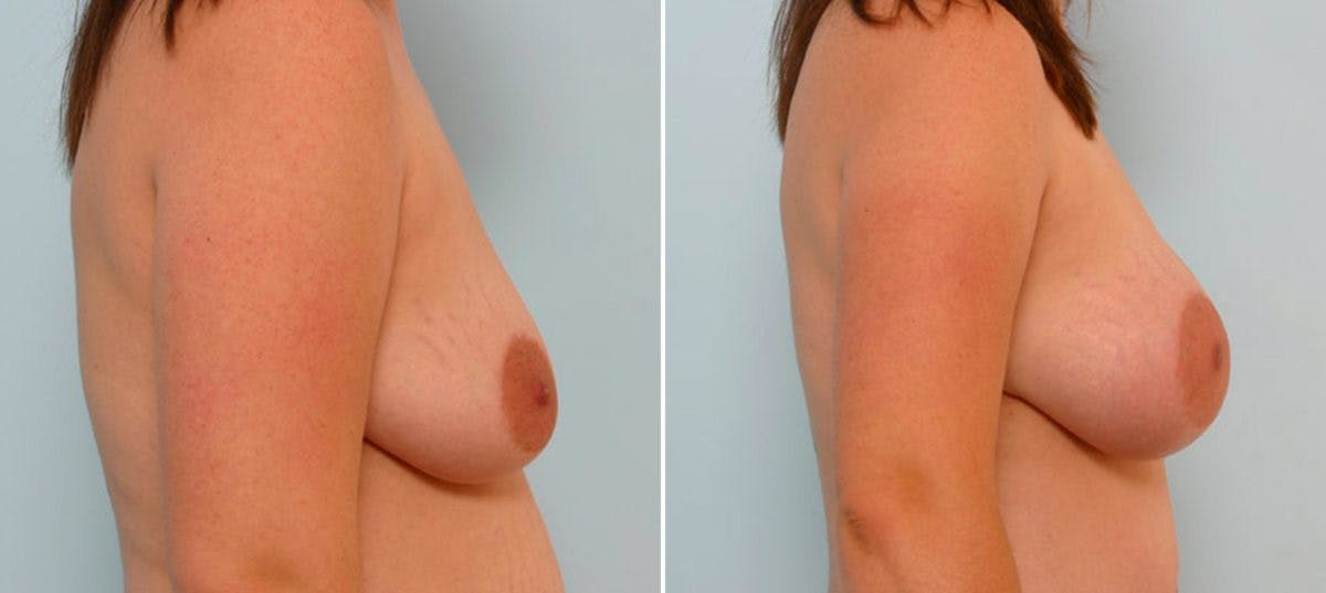 Breast Augmentation Before & After Gallery - Patient 54886655 - Image 3