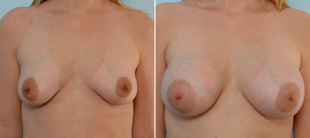 Breast Augmentation Before & After Gallery - Patient 54886656 - Image 1