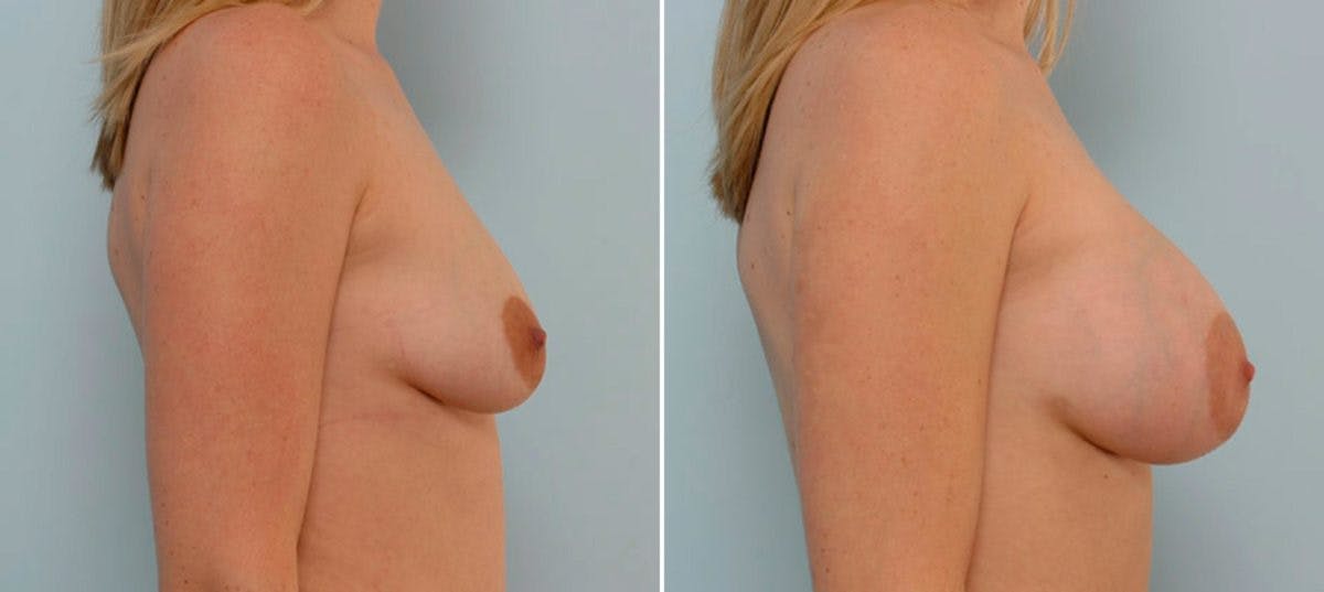 Breast Augmentation Before & After Gallery - Patient 54886656 - Image 3